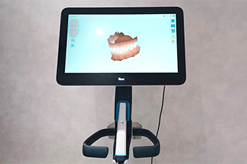 口腔内スキャナーを使用した矯正治療